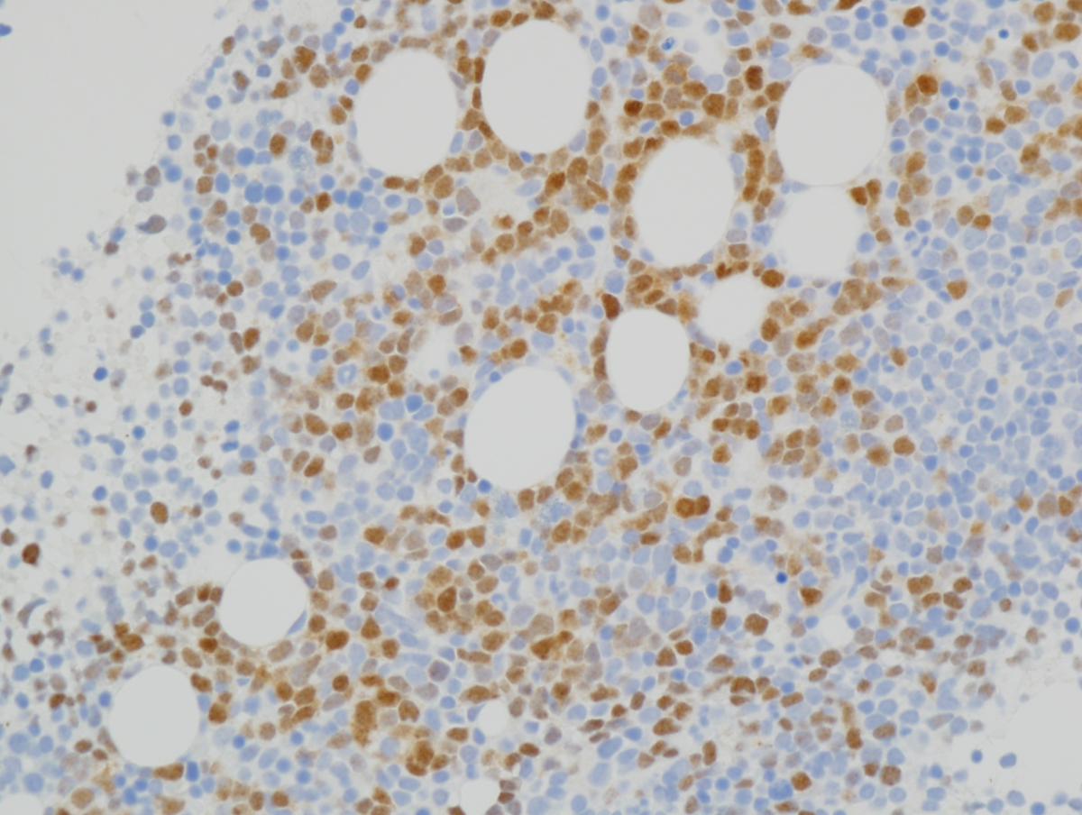 Figure 5(TdT): Immunohistochemistry of bone marrow clot sections (400x magnification).